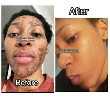 Load image into Gallery viewer, How I Cleared my Stubborn Hormonal Acne of 6 Years!
