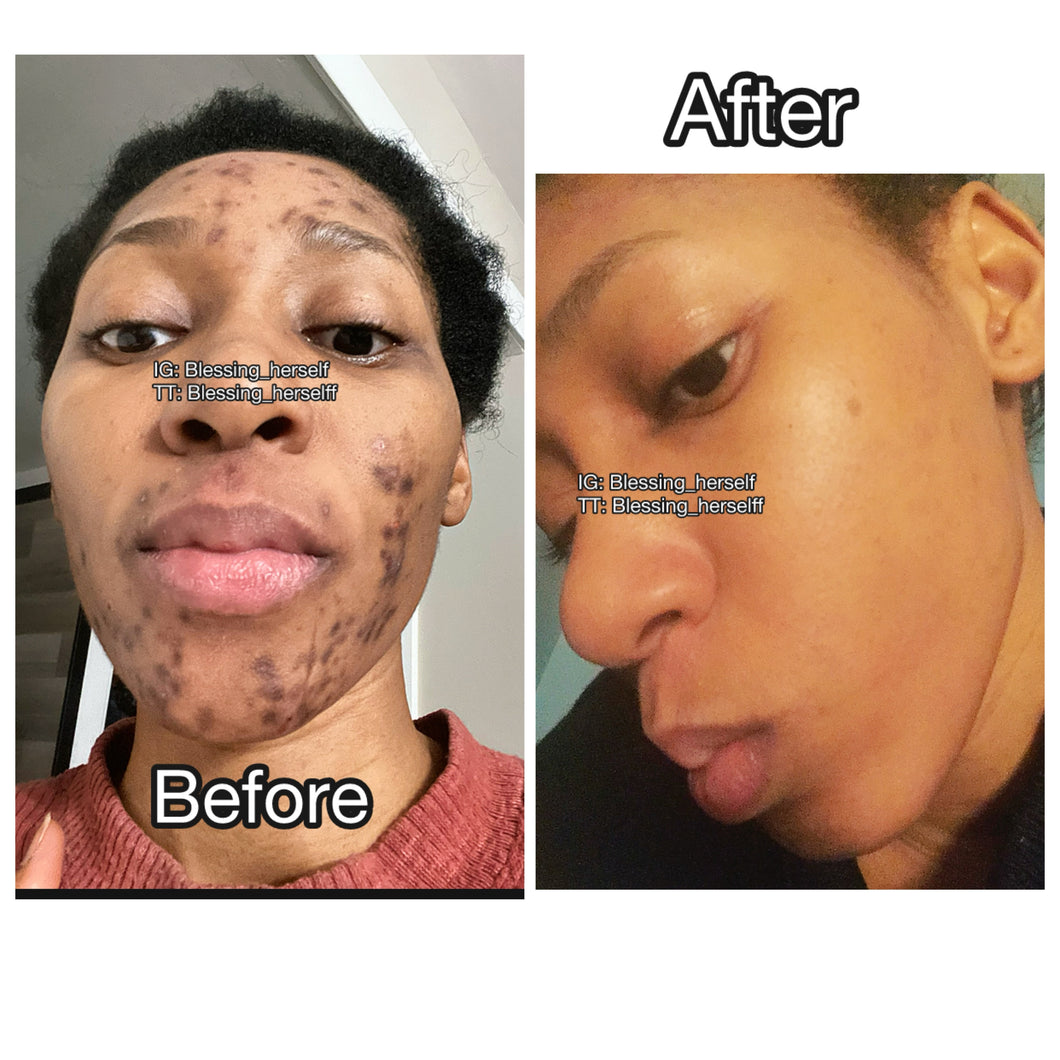 How I Cleared my Stubborn Hormonal Acne of 6 Years!