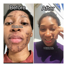 Load image into Gallery viewer, How I Cleared my Stubborn Hormonal Acne of 6 Years!
